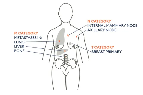TNM Classification of Malignant Tumours | UICC
